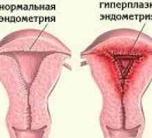 Glandulocystica hiperplazija endometrija