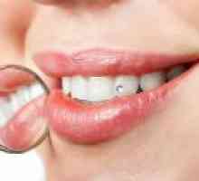 Dental polnila - Merila za izbor