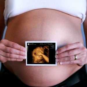 3D ultrazvok v nosečnosti