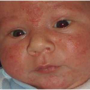 Alergijski izpuščaji pri otrocih