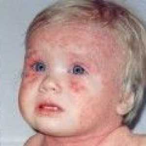 Atopijski dermatitis pri otrocih simptomih in zdravljenju