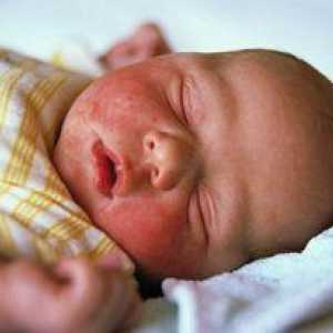 Atopijski dermatitis pri dojenčkih: varno in učinkovito zdravljenje