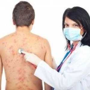 Alergični na kožo, alergijski kožni izpuščaj