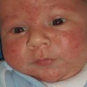 Mleko alergije pri otroku