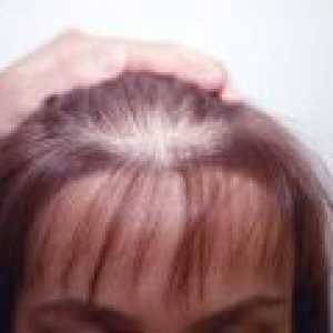 Androgene alopecije pri ženskah, simptomi, zdravljenje