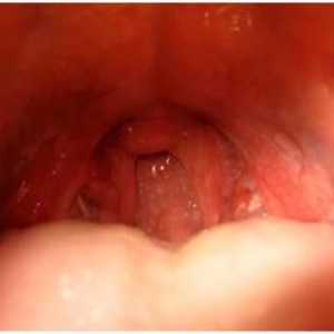 Lacunar angina - Simptomi in zdravljenje, lacunar mandljev pri otrocih