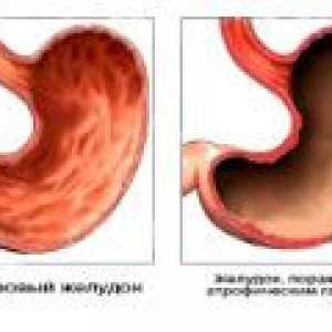 Antralnih atrofični gastritis: Vzroki, simptomi, zdravljenje