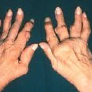 Artritis sklepov prstov: Simptomi in zdravljenje