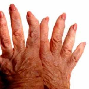 Osteoartritisa prstih, simptomih in zdravljenju