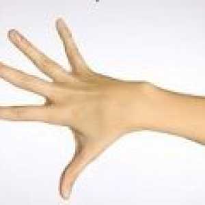 Osteoartritis prstov, sklepi prstov, kako ravnati?