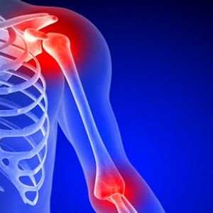 Osteoartritis od ramenskega sklepa: Simptomi in zdravljenje
