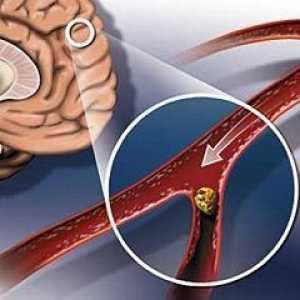 Možganska ateroskleroza
