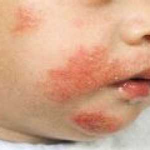 Atopijski dermatitis pri dojenčkih - Simptomi, Zdravljenje
