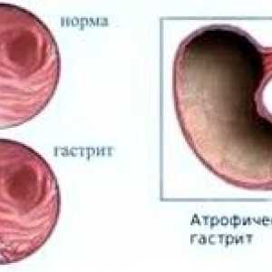 Atrofični gastritis: simptomi, zdravljenje