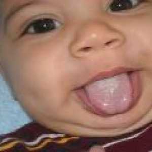 Bel jezik premaz pri dojenčkih - vzroki, simptomi, zdravljenje