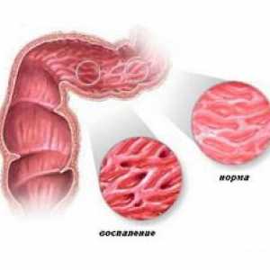 Crohnova bolezen