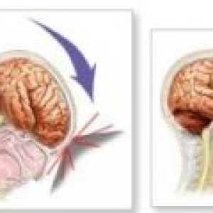 Travmatska poškodba možganov - posledice, rehabilitacija