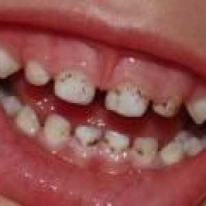 Kaj storiti, če vaš otrok zobne obloge na zobeh?