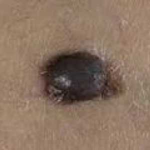 Kaj je melanom in kako preprečiti njegovo pojavljanje