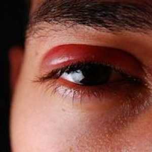 Kaj je hladno boleče oči?