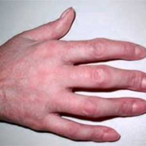 Deformacija prsta