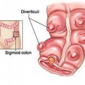 Divertikulitis - simptomi, zdravljenje, divertikulitis od sigmoidno debelega črevesa