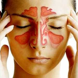 Sinusitis: simptomi in zdravljenje