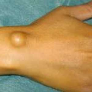 Hygroma zapestje: vzroki in zdravljenje