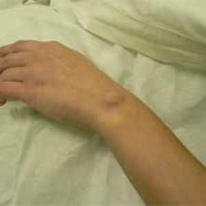 Hygroma zapestja, roke, skupno - hygromas zdravljenja