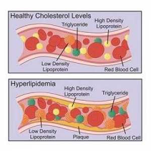 Hiperlipidemija