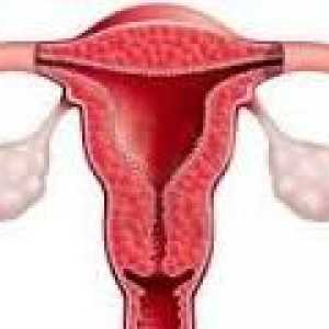 Hiperplazija endometrija po kiretaža