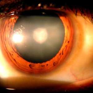 Očesni tlak: simptomi in zdravljenje