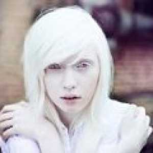Oculocutaneous albinizem: vzroki, simptomi, zdravljenje
