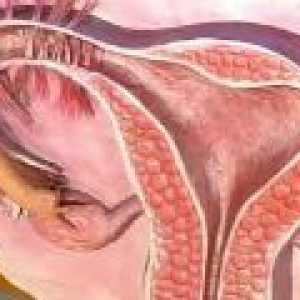 Kronična endometrija rak - vzroki, simptomi, zdravljenje