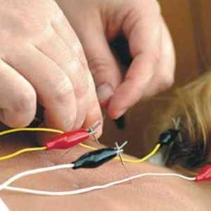 Akupunktura kila ledvenega dela hrbtenice: pregledi bolnikov in strokovnjakov