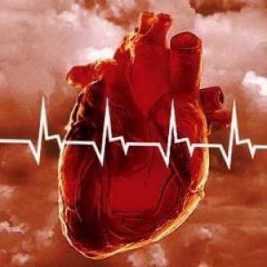 Miokardni infarkt