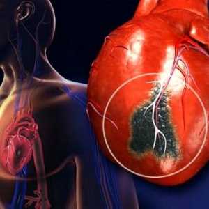 Srčni infarkt pri moških in ženskah: simptomi in znaki