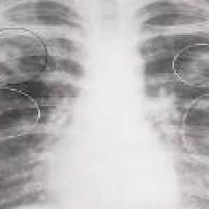 Infiltracijsko pulmonalne tuberkuloze: simptomi, faza, zdravljenje