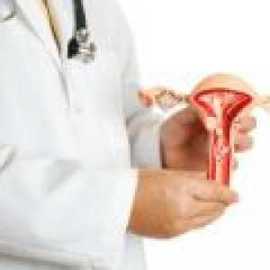Vrinjeni fibroidi - vzroki, simptomi, zdravljenje