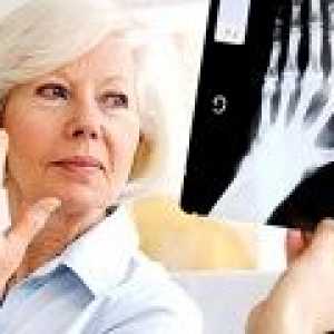 Invalidska pri revmatoidnem artritisu: Vzroki