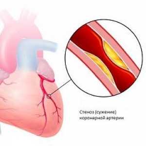 Bolezen koronarnih arterij