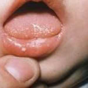 Razjede v ustih: vzrokov. zdravljenje
