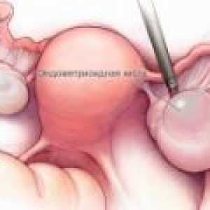 Endometrioid cist jajčnikov - vzroki, simptomi, zdravljenje