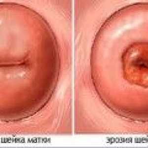 Erozija materničnega vratu in nosečnost