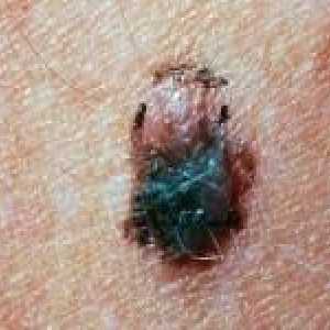 Kako, da si opomore od melanoma
