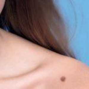 Kako prepoznati in zdraviti melanom kože