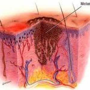 Kako je razlika diagnozo melanoma