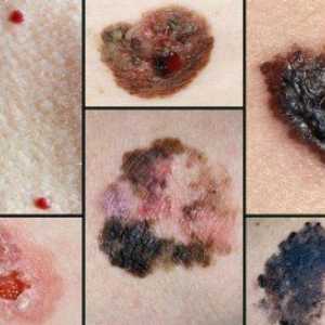 Katere lastnosti so značilne za razvoj melanoma in kako namestiti napoved