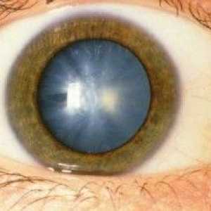 Katarakte - ena izmed najpogostejših bolezni oči