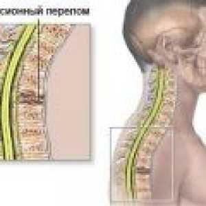 Zlom stiskanje hrbtenice, simptomi, zdravljenje